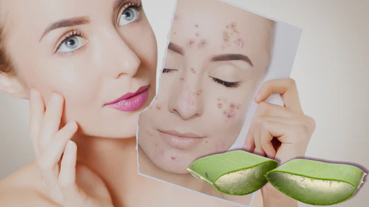 HOW ALOE VERA IS SUITABLE FOR ACNE & SKIN RASHES